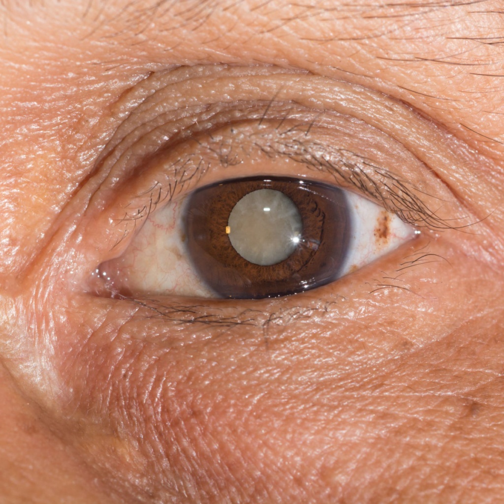 Лечение и удаление катаракты, операция